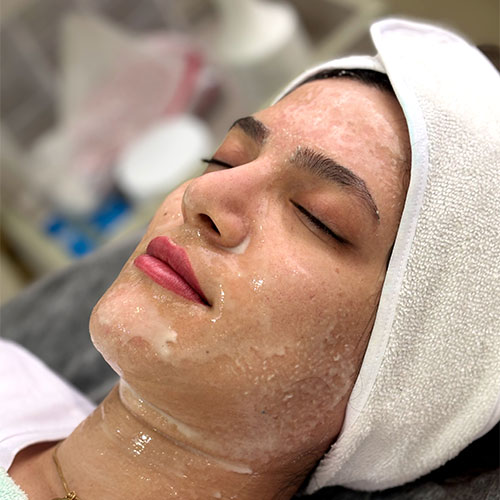 مزونیدلینگ